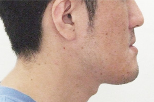 30代男性・口腔外科して外科手術を併用した矯正治療で下顎前突（受け口・しゃくれ）・顎変形症を改善した症例