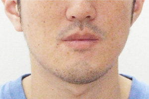 30代男性・口腔外科と連携して外科手術を併用した矯正治療で下顎前突（受け口・しゃくれ）・顎変形症を改善した症例｜治療後の正面｜神奈川県秦野市の歯医者「高橋矯正歯科医院」