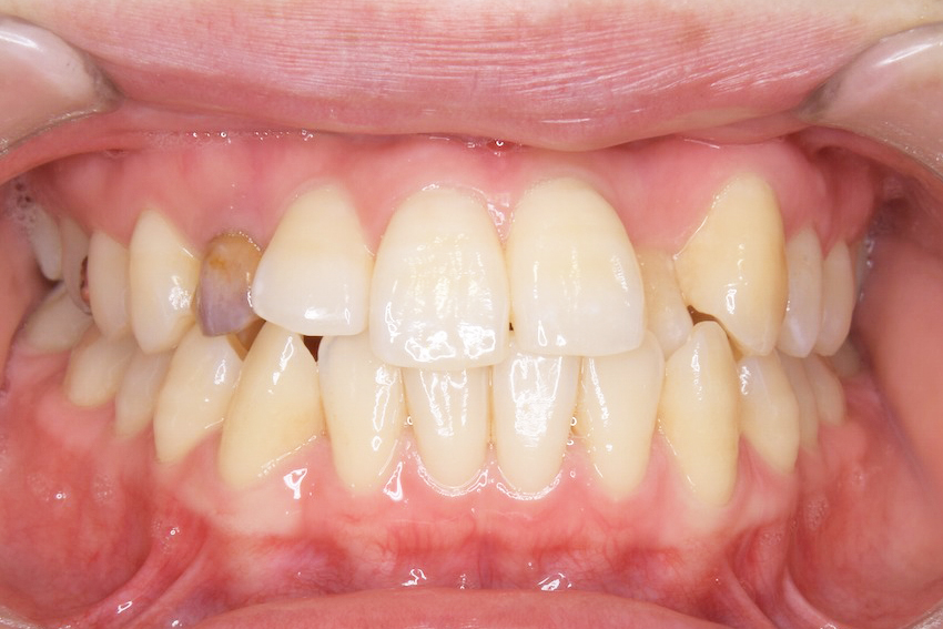 20代女性「乳歯が残っている。歯もでこぼこに生えている」埋まった永久歯と残った乳歯を抜いてから、ワイヤー矯正と金属のネジ「アンカースクリュー」の併用で歯並びと口元を整えた症例