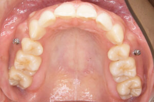 10代女性「出っ歯を治したい」インプラントアンカーを用いて矯正治療した症例｜治療後の上の口｜神奈川県秦野市の歯医者「高橋矯正歯科医院」