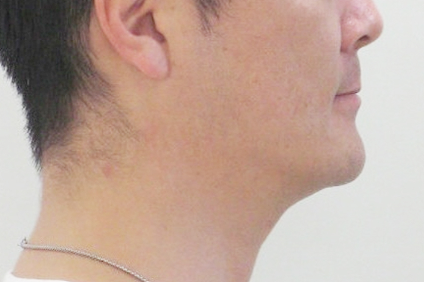 30代男性「下あごが出ているのが気になる。受け口を治したい」手術なしで、ワイヤーと金属のネジ「アンカースクリュー」を併用した矯正で噛み合わせを ...